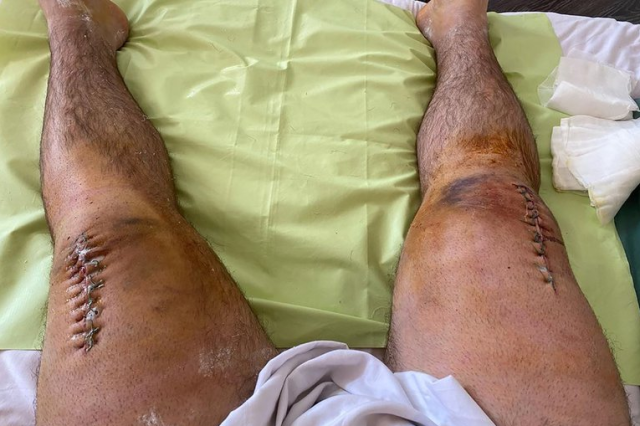 Así evoluciona el pesista que se fracturó las rodillas cuando intentó levantar 400 kilos