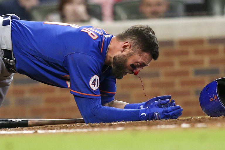 Así quedó el rostro del jugador de la MLB que recibió un pelotazo a más de 150 kilómetros por hora